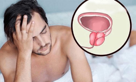 Prostatitis Symptome