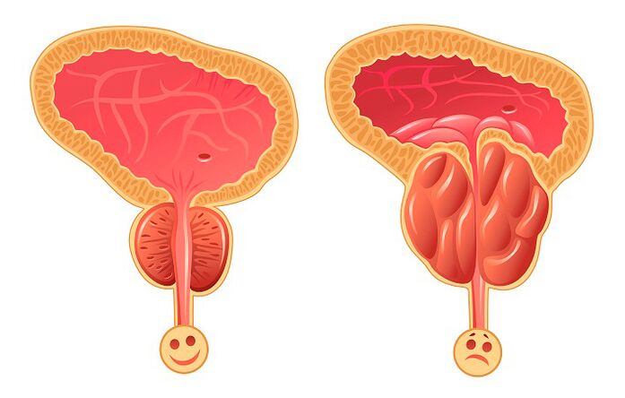 Normale und entzündete Prostata.