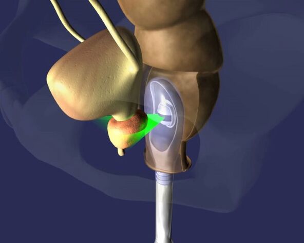 Prostata-Ultraschallbehandlung bei Prostatitis