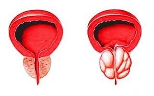 Prostata im Normalzustand (links) und mit Prostatitis entzündet (rechts)