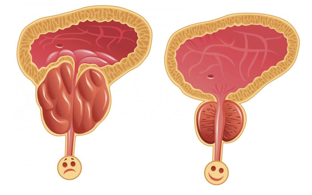 Entzündung der Prostata mit Prostatitis (links) und die Prostata ist normal (rechts)